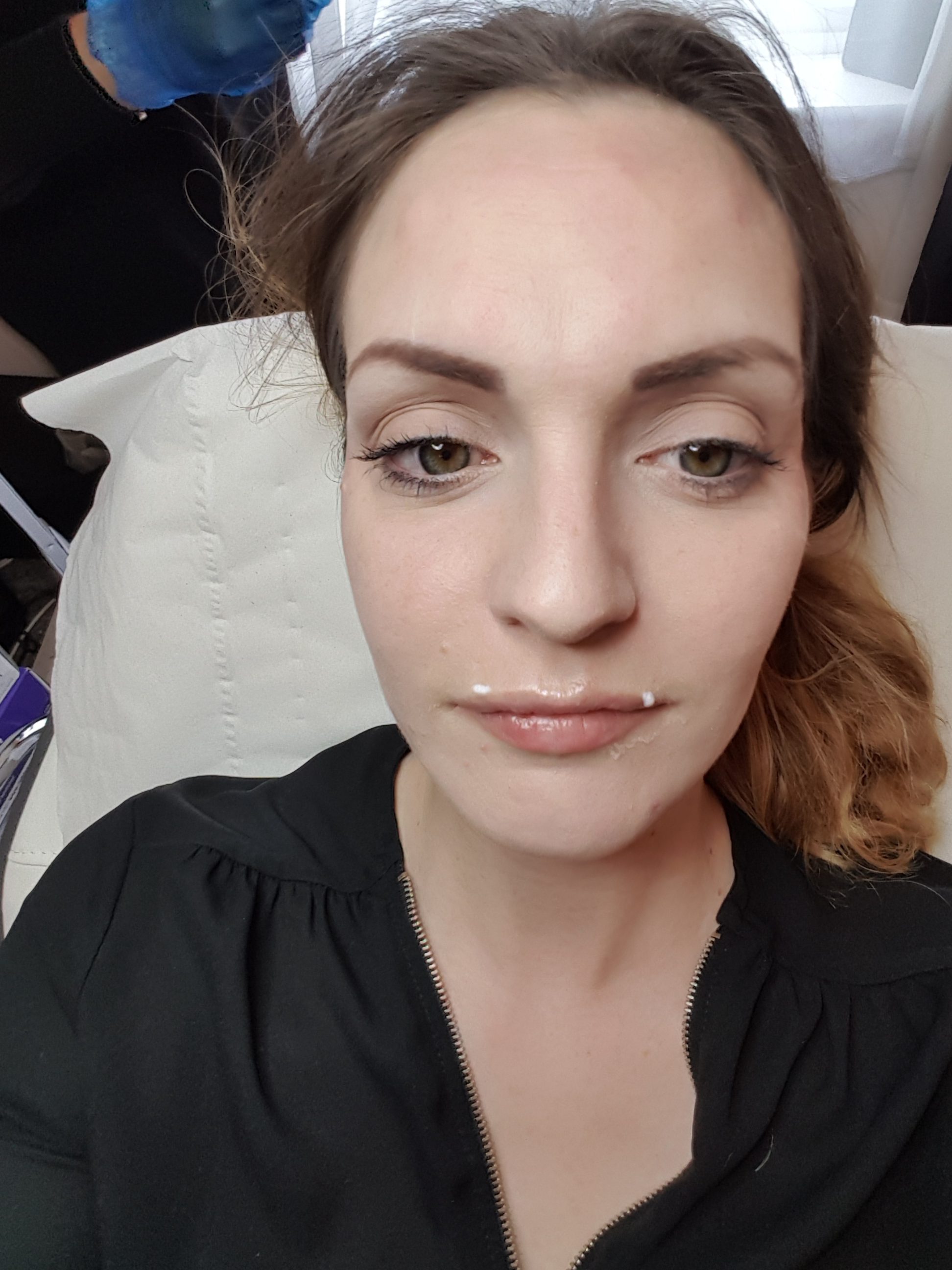 Lip filler and Botox review- hampton Aesthetic clinic Revolax